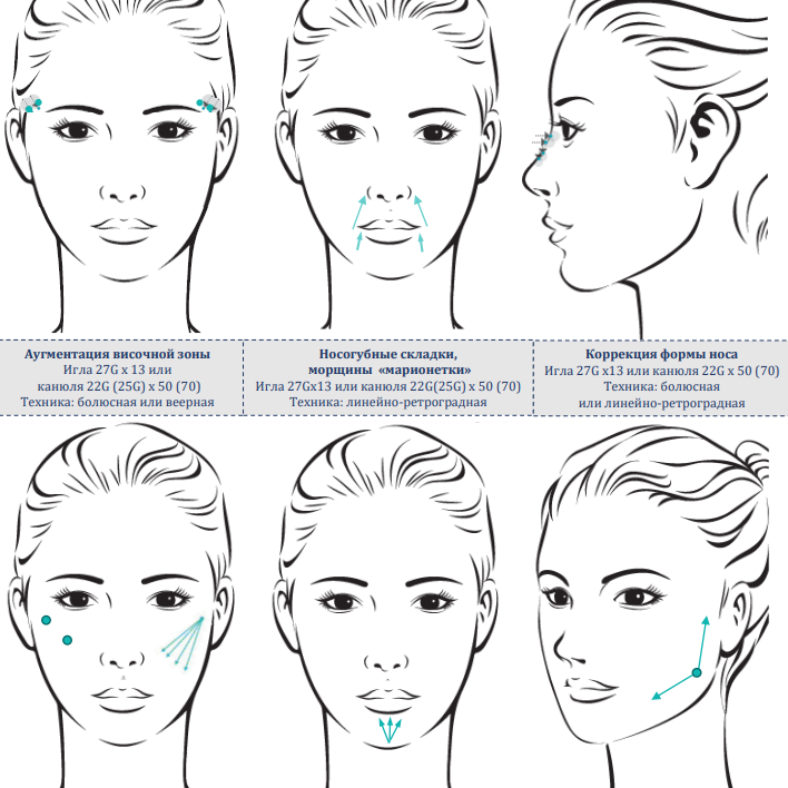 Neuramis Volume Lidocaine - Нейрамис Волюм с лидокаином