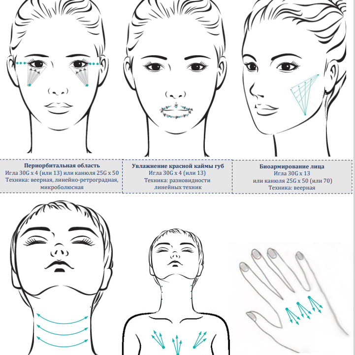 Neuramis Lidocaine - Нейрамис Лидокаин